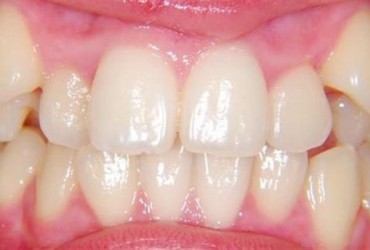 ارتودنسی دندان نیش |درمان ارتودنسی دندان نیش