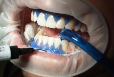 مراحل انجام بلیچینگ دندان | نحوه بلیچینگ (سفید کردن دندان)