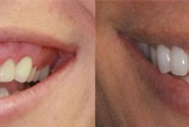 افزایش طول  تاج دندان با لیزر | مراقبت بعداز افزایش طول تاج دندان با لیزر