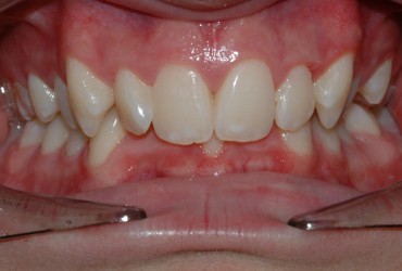 دیپ بایت دندان | درمان دیپ بایت دندان