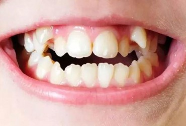 نامرتبی و شلوغی دندانها | علت نامرتبی و شلوغی دندانها