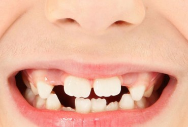 دلایل تاخیر در بیرون زدن دندان دائمی | در نیامدن دندان دائمی 