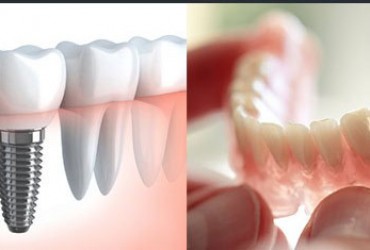 فرق دندان مصنوعی و ایمپلنت چیست؟ | دندان مصنوعی یا ایمپلنت دندان