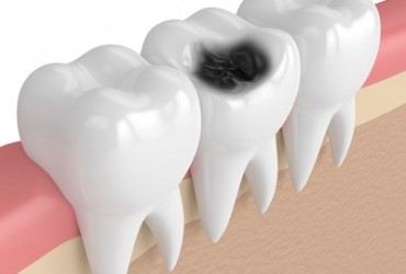 عوامل  ایجاد پوسیدگی دندان | علت پوسیدگی دندان 