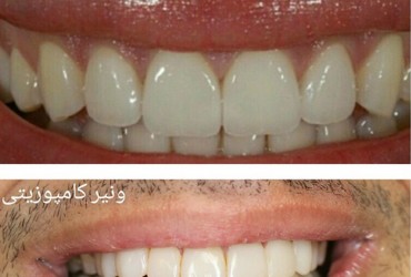 تفاوت کامپوزیت و لمینت دندان 