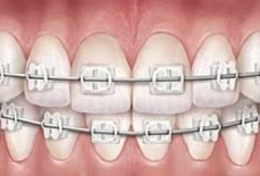 ارتودنسی چیست؟ | انواع ارتودنسی دندان
