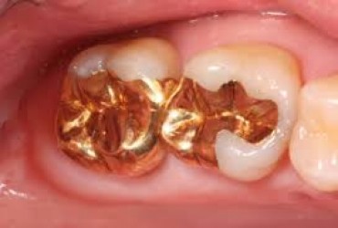 پرکردن دندان با مواد | مراحل پر کردن دندان 