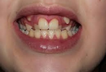 مزیودنس (دندان اضافی) | بیرون زدن دندان اضافه 