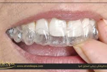بلیچینگ(سفیدکردن دندان) | همه چیز در مورد بلیچینگ دندان