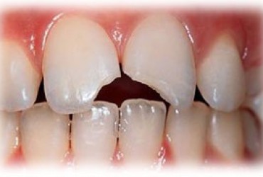 ترک دندان | علائم ترک دندان 
