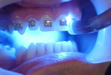 کامپوزیت های نوری | همه چیز در مورد کامپوزیت های نوری دندان