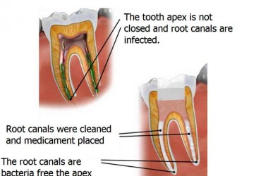 اپکسیفیکاسیون دندان | درمان اپکسیفیکاسیون دندان 