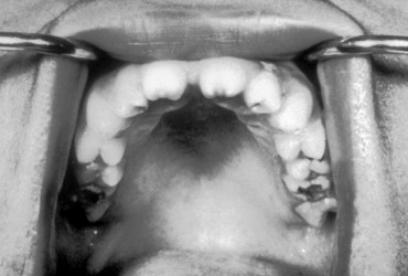 دندان هوچینسون | درمان دندان هوچینسون