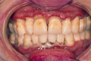 دهان خندقی (ژنژیویت) | درمان دهان خندقی (ژنژیویت)