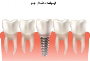ایمپلنت قدامی (دندان جلو ) | بهترین ایمپلنت قدامی