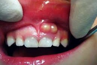  دندان عفونی | تشخیص دندان عفونی 