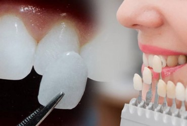 لومینیرز دندان | درمان لومینیرز دندان 