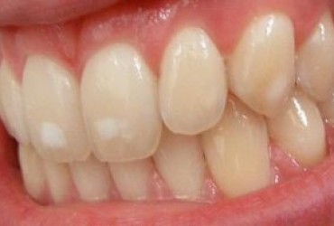 فلوروسیس ( لکه سفید روی دندان ) | علت به وجود آمدن فلوروسیس 