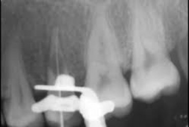 پرفوریشن ریشه دندان | تشخیص پرفوریشن ریشه دندان