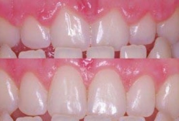 جراحی افزایش طول تاج دندان  |قیمت جراحی افزایش طول تاج دندان