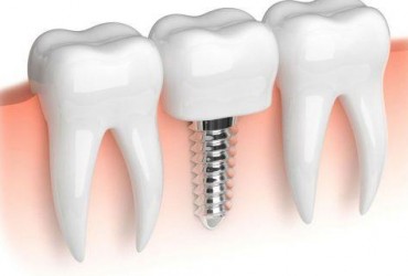 معایب و مزایای ایمپلنت دندان | فواید و مضرات ایمپلنت دندان