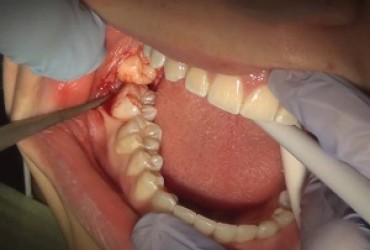 عوارض  کشیدن دندان عقل | جراحی دندان عقل