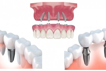  مراحل  کاشت ایمپلنت دندان | نحوه کاشت ایمپلنت