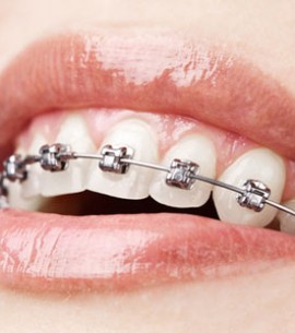 عمر ایمپلنت دندان چقدر است؟ | طول عمرایمپلنت دندان