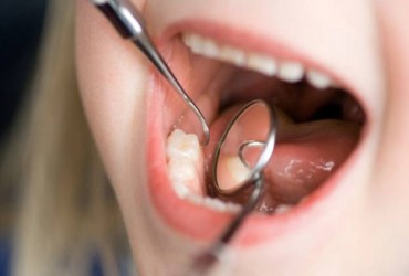 درزگیری  یا سیلانت دندان پوسیده 