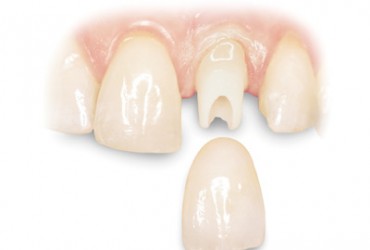 پروتز دندان | انواع پروتز دندان