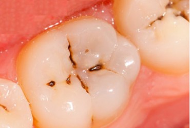 پوسیدگی دندان | درمان پوسیدگی دندان