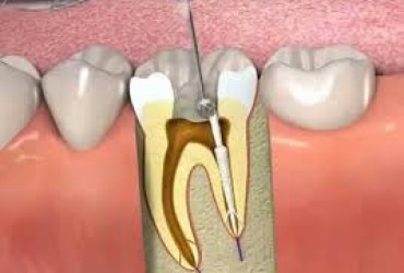 عصب کشی دندان | هزینه عصب کشی دندان