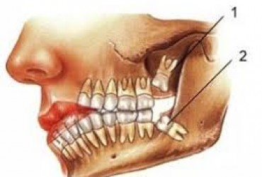 آنچه که درباره دندان عقل باید بدانید | علائم درد دندان عقل