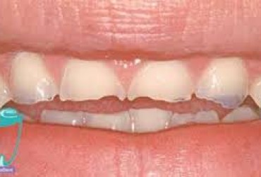 ساییدگی دندان | علل ساییدگی دندان 