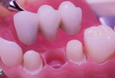 بریج دندان | قیمت بریج دندان