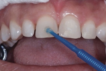 باندینگ دندان چیست؟ | هزینه باندینگ دندان