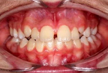 ناهماهنگی خط وسط دندان | درمان ناهماهنگی خط وسط دندان