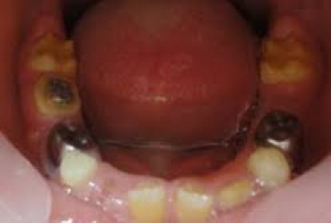 نقص مینای دندان | نقص ژنتیکی مینای دندان