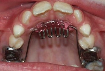 جلو زدن دندان ها در اثر فشار زبان | درمان جلو زدن دندان در اثر فشار زبان