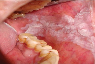 لکوپلاکیا یا زخم های سفید دهان | ضایعات لکوپلا کیا یا زخم های سفید دهان