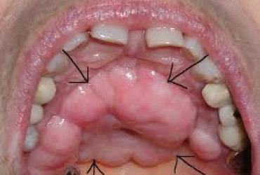 رشد استخوان در دهان | زائده استخوانی در دهان