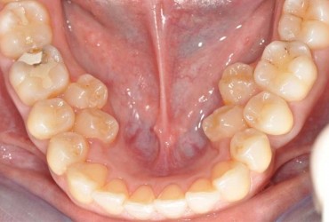 دندان های اضافی دهان | مشکل دندان اضافی در دهان