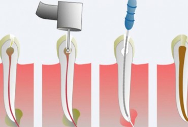 مراحل عصب کشی  دندان | چگونگی عصب کشی دندان 