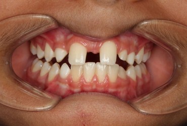 هایپودونتیا (کمبود دندان مادرزادی) | کمبود دندان مادرزادی 