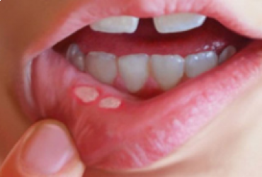 عوارض شیمی درمانی بر روی دهان و دندان | کاهش عوارض  شیمی درمانی برروی دهان ودندان