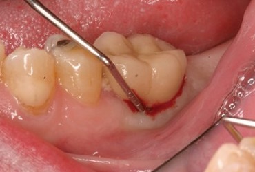 عوارض ایمپلنت دندان | مشکلات ایمپلنت دندان